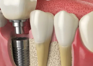 The Role Of Technology In Dental Implant Surgery