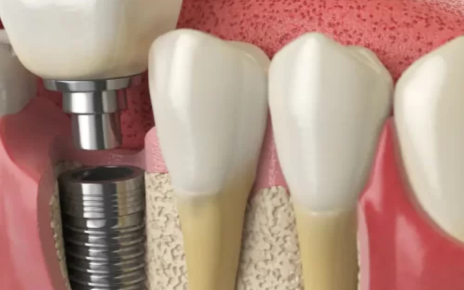 The Role Of Technology In Dental Implant Surgery