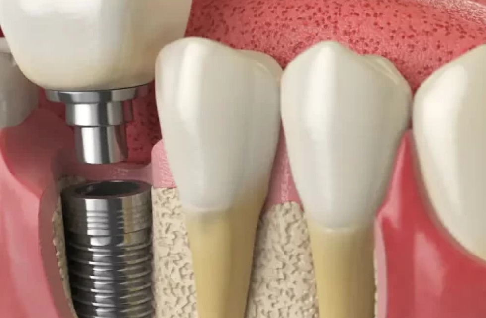 The Role Of Technology In Dental Implant Surgery